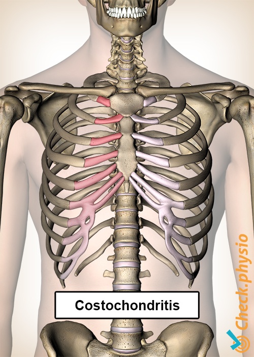 costochondritis ribben smerte bryst brystben
