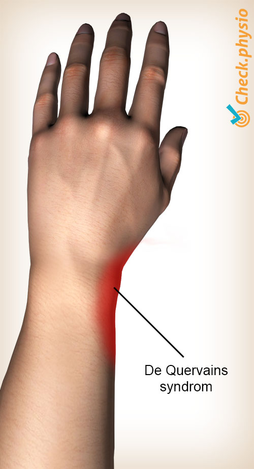arm de Quervain placering