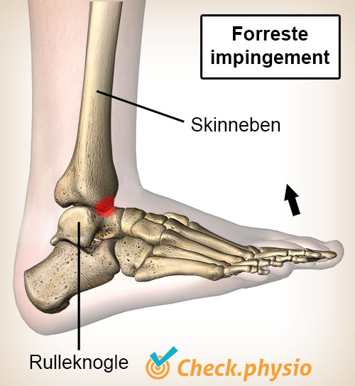 ankel anterior impingement dorsal fleksion