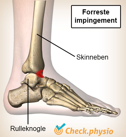 ankel anterior impingement