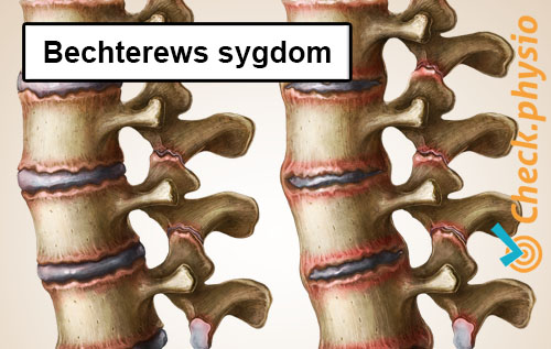 ryg specifik lændesmerter Bechterews sygdom spondylitis ankylopoietica