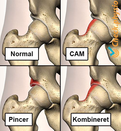 hofte impingement FAI typer