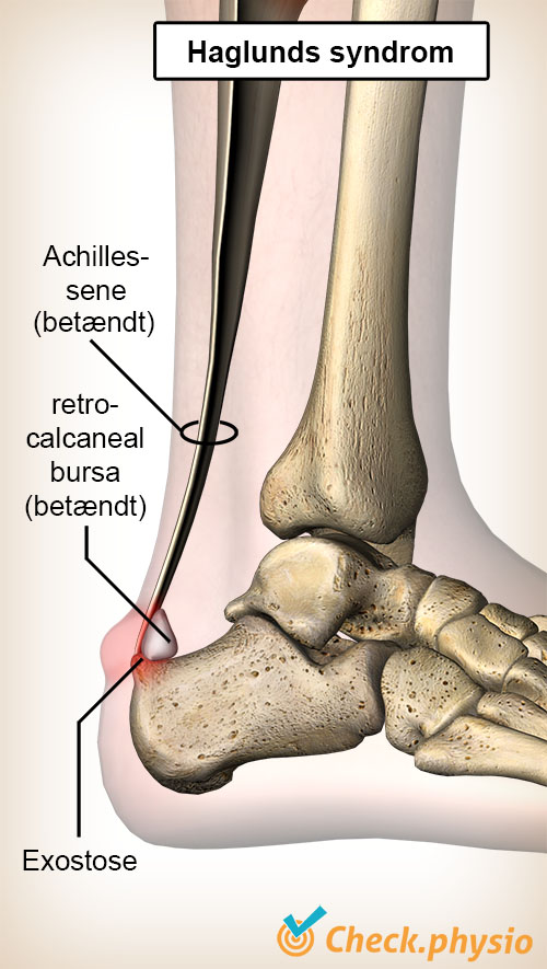 ankel Haglunds syndrom achillessene retrocalcaneal bursa hælben calcaneus