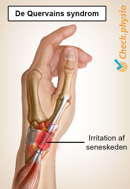 arm de Quervain