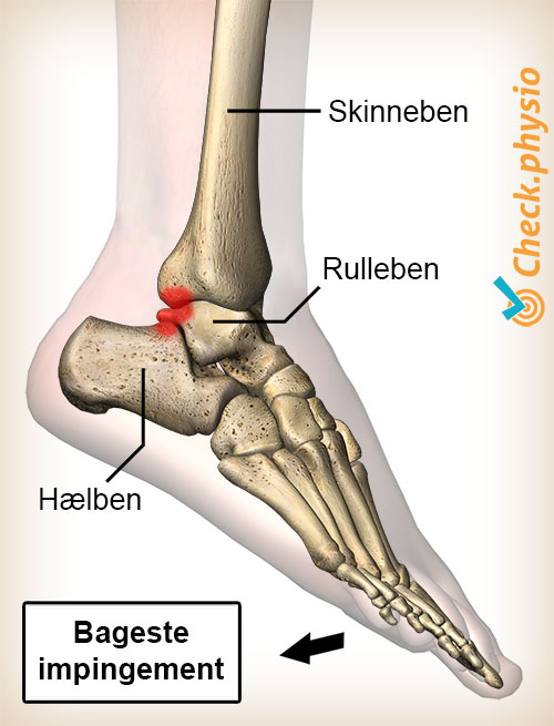 ankel posterior impingement plantar fleksion