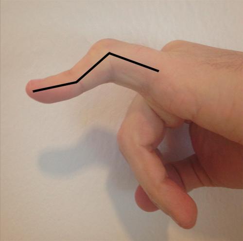 hånd boutonnière deformitet