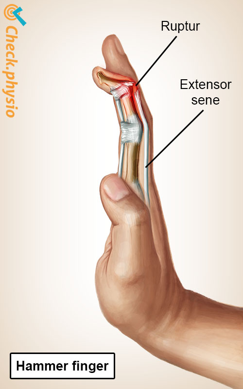 hånd mallet finger