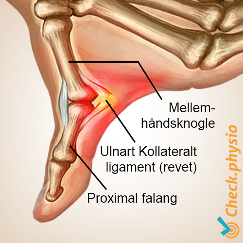 hånd skitommelfinger anatomi ligamentum collaterale ulnare