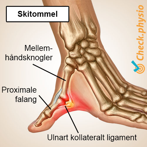 hånd skitommelfinger