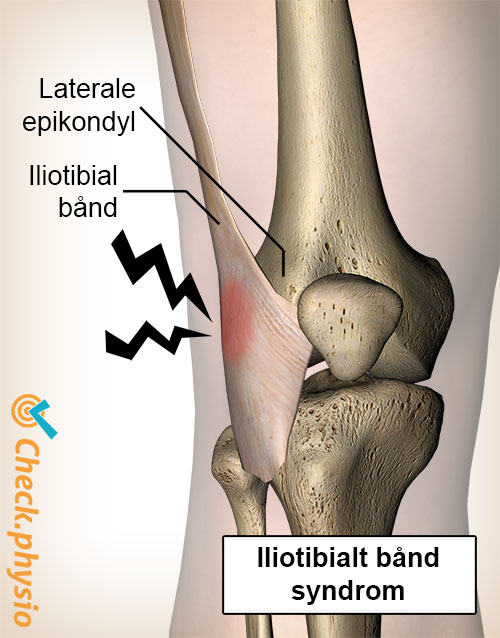 knæ iliotibialbåndsyndrom laterale epikondyl