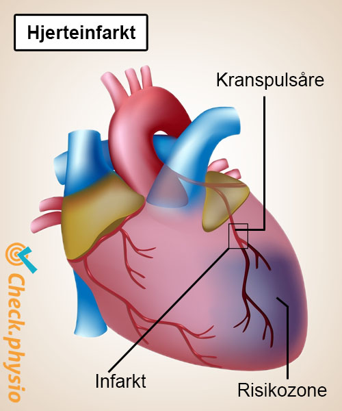 hjerte hjerteanfald kranspulsåre anatomi
