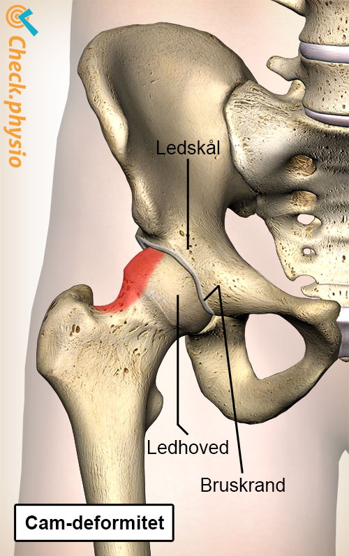 hofte femoroacetabulær impingement FAI cam