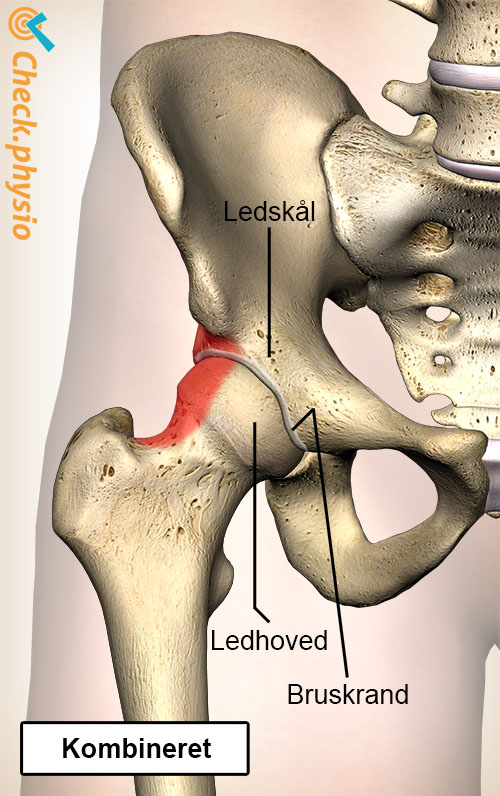 hofte femoroacetabulær impingement FAI kombineret type