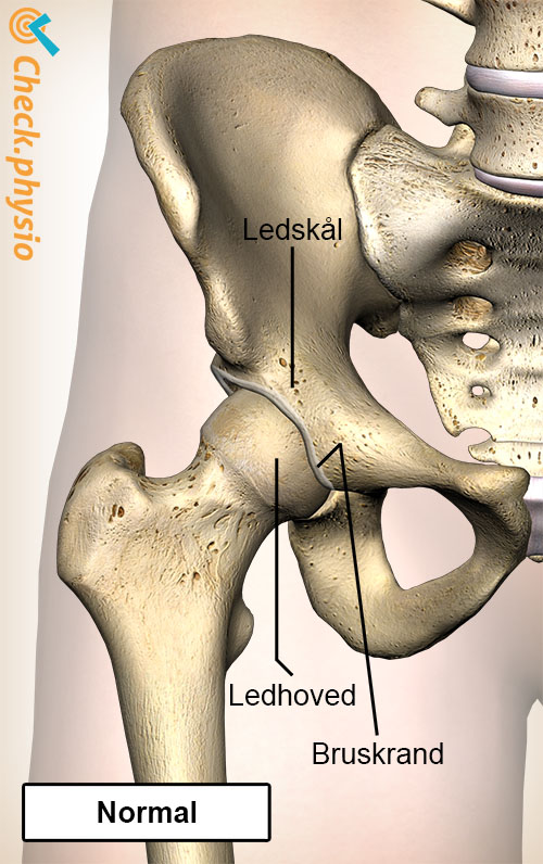 hofte femoroacetabulær impingement FAI normal