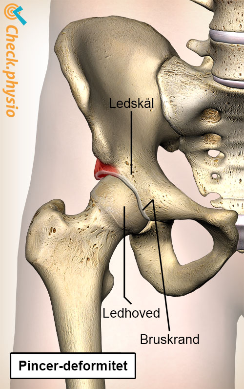 hofte femoroacetabulær impingement FAI pincer