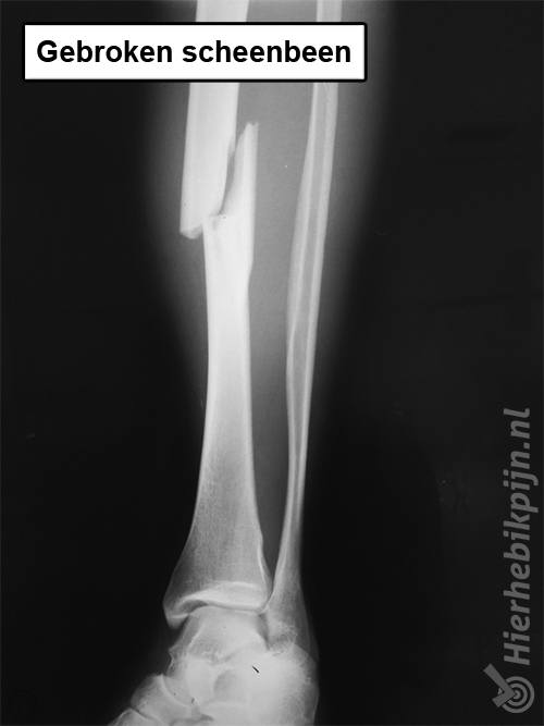 Gebroken scheenbeen tibia fractuur onderbeen rontgenfoto